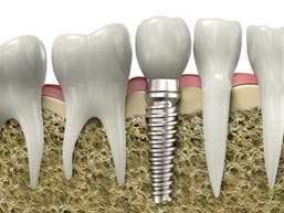 implantologie-implant-poitiers-montamise-1