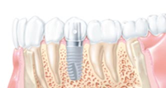 implantologie-implant-poitiers-montamise