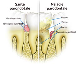 parodontologie-poitiers-montamise-2